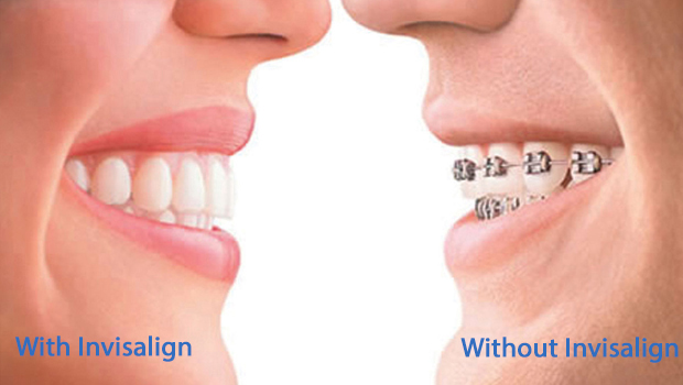 Invisalign in Winchester