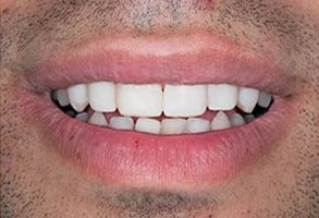 Winchester Before and After Veneers