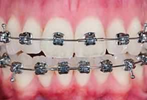 Before and After Dental Braces in Winchester